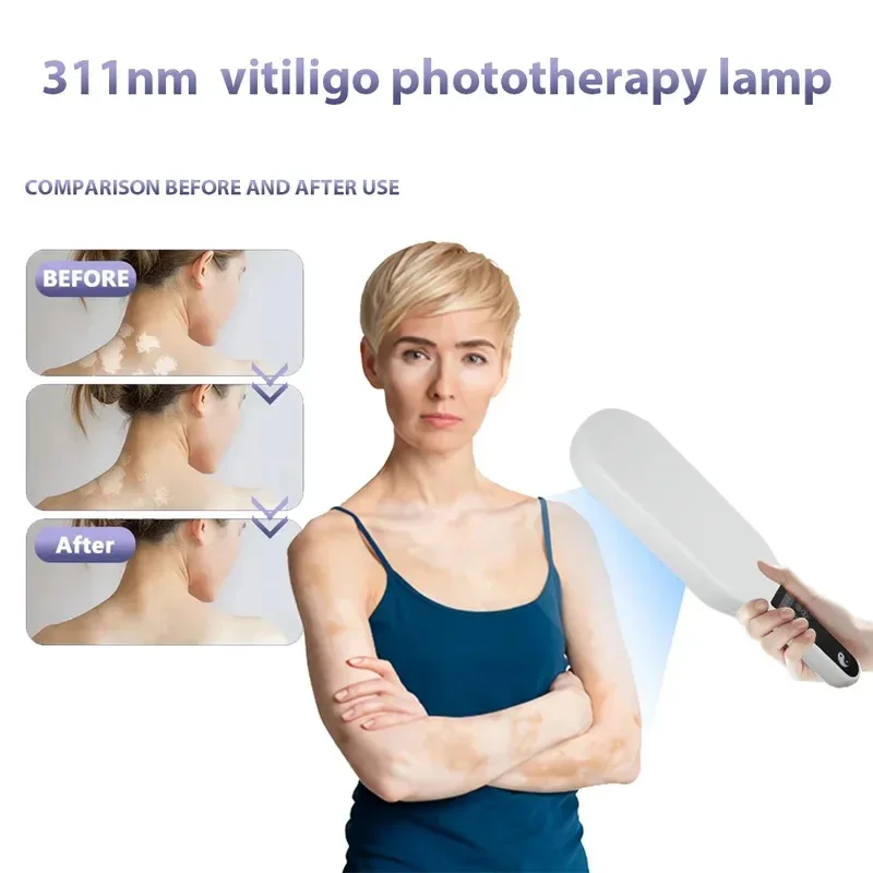 311nm Double Tube Narrow-Band UVB Phototherapy Lamp Ultraviolet Treatment Instrument for Skin Conditions